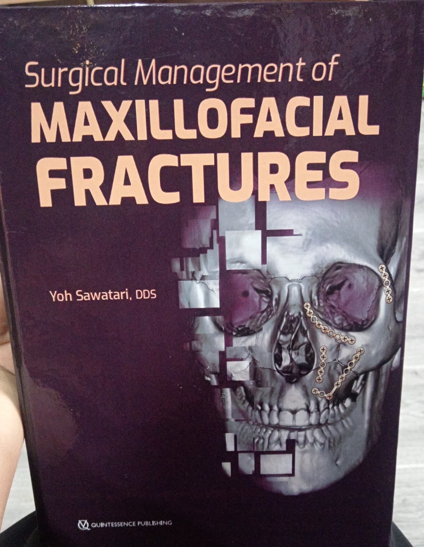 Maxillofacial fractures
